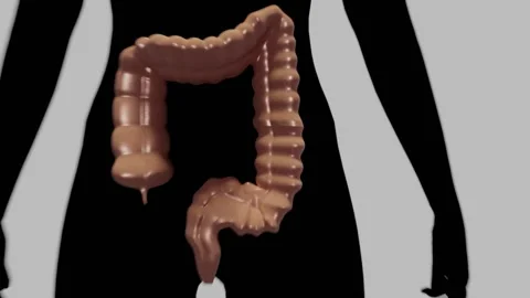 Body to Colon to Large intestine to growing polyp Stock Footage