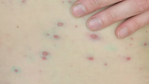 Body infected with monkeypox Stock Footage 196149597