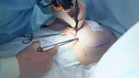 Body surgery medical operation clouseup Stock Footage 150888053