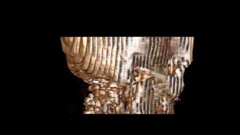 Bone 3.0 PLAIN STUDY Coronal-VR-movie Stock Footage 319124503