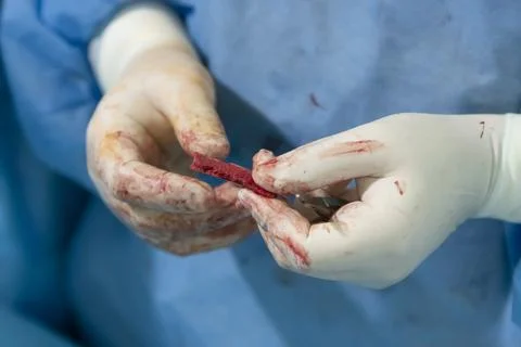 Bone Autograft Close-up Stockfoto's