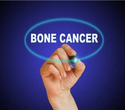 Bone cancer Stock Illustration
