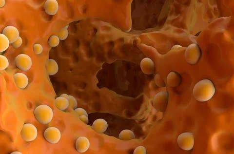 Bone cancer (osteosarcoma) Illustrazione stock