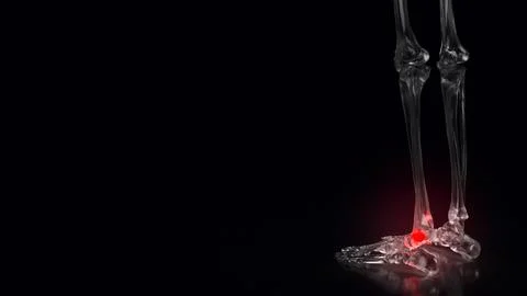 The Bone crystal for sprained ankle concept 3d rendering. Stock Photos