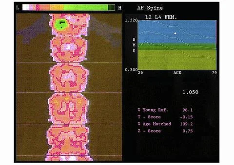  Bone densitometry result Bone mineral density test (lumbar vertebrae). Th... 库存照片