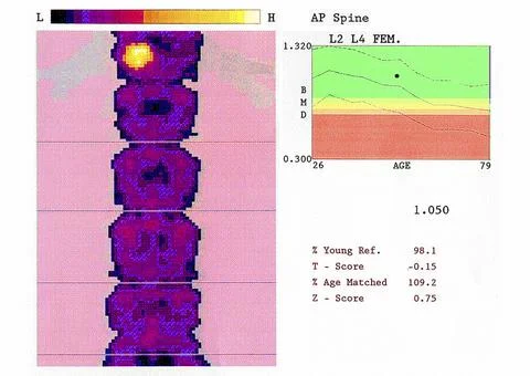  Bone densitometry result Bone mineral density test (lumbar vertebrae). Th... 库存照片