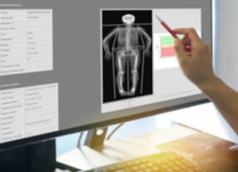 Bone Densitometry Result Stock Photos