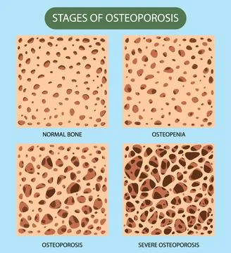 Bone Density and Osteoporosis Vector Illustrazione stock
