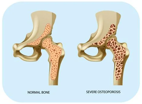 Bone Density and Osteoporosis Vector Illustrazione stock