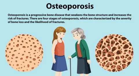 Bone Density and Osteoporosis Vector Illustrazione stock