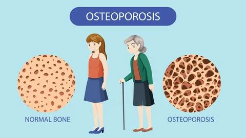Bone Density and Osteoporosis Vector Illustrazione stock