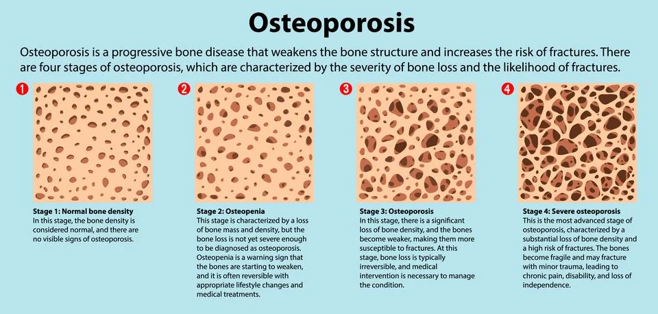 Bone Density and Osteoporosis Vector Illustrazione stock