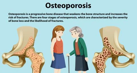 Bone Density and Osteoporosis Vector Illustrazione stock