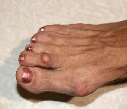 A bone on the foot. Bump on the toe. Stock Photos