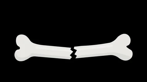 Bone Fracture and Broken Bone Symbol Animation isolated on black background.. Stock Footage 304775106