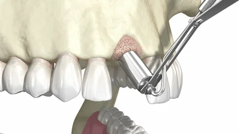 Bone grafting- augmentation using artificial bone and membrane Stock Footage 129539068