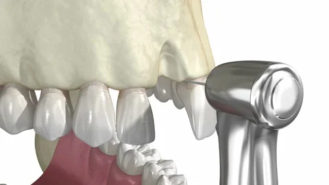 Bone grafting- augmentation using block of bone, tooth implantation Stock Footage 129539873