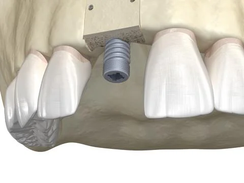 Bone grafting- augmentation using block of bone, tooth implantation. Illustrazione stock