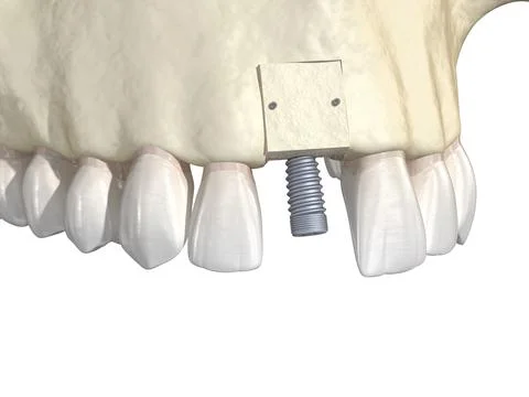 Bone grafting- augmentation using block of bone, tooth implantation. Illustrazione stock