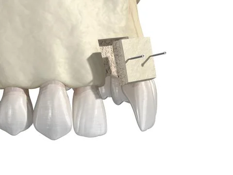 Bone grafting- augmentation using block of bone, tooth implantation. Ilustração Stock