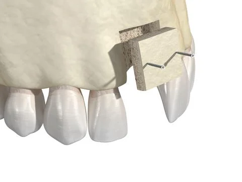 Bone grafting- augmentation using block of bone, tooth implantation. Illustrazione stock