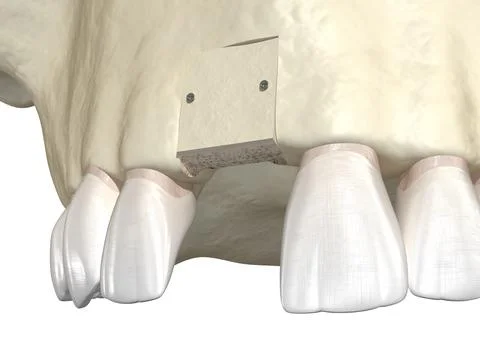 Bone grafting- augmentation using block of bone, tooth implantation. Illustrazione stock