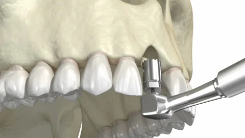 Bone grafting- augmentation using ring method, tooth implantation Stock Footage 129326527