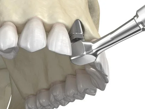 Bone grafting- augmentation using ring method, tooth implantation. Stock Illustration