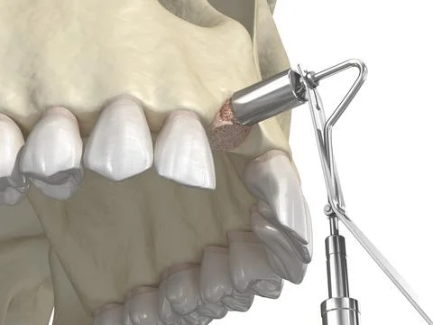 Bone grafting- augmentation using ring method, tooth implantation イラスト素材