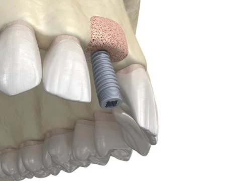 Bone grafting- augmentation using ring method, tooth implantation. Stock Illustration