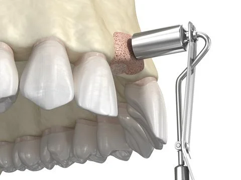 Bone grafting- augmentation using ring method, tooth implantation. Stock Illustration