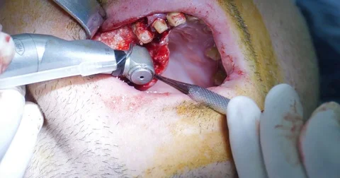 Bone grafting surgical procedure Video stock 70171884