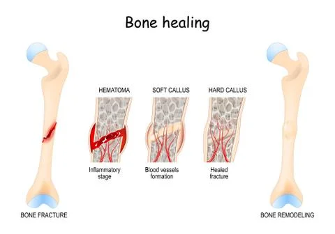 Bone healing Process after a bone fracture. Stock Illustration