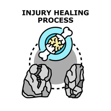 Bone injury healing process vector concept Stock Illustration