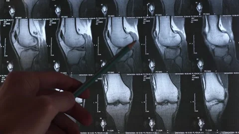 Bone knee Stock Footage 276286450