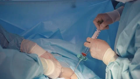 Bone marrow transplant operation. Team surgeons operation bone marrow transplant Stock Footage