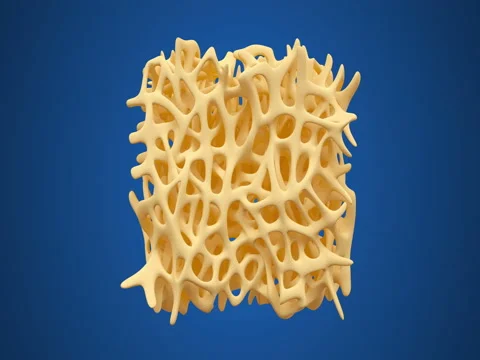 Bone osteoporosis animation Stock Footage