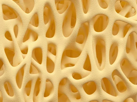 Bone osteoporosis animation | Stock Video | Pond5