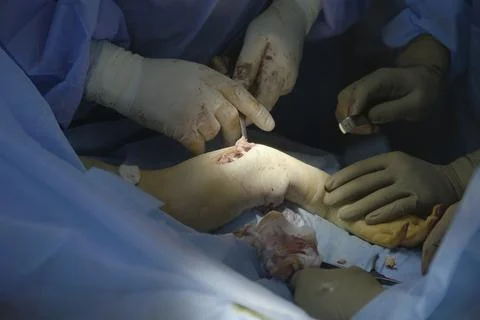 Bone Outside the Arm Stockfoto's