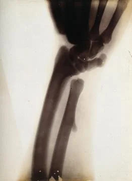 The bones of a forearm, viewed through x-ray. Photoprint from radiograph af.. Stock Photos