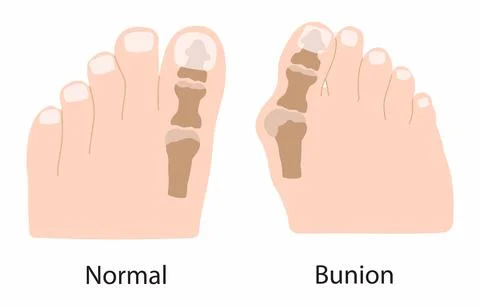 The bones in the front part of foot move out of place Stock Illustration