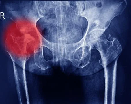 Both hips joint x-ray showing destruction head right femur and erosion acetab Stock Photos