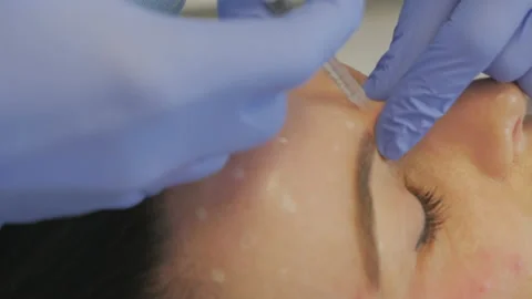 Botox Injecting In The Glabella Stock Footage 130942991