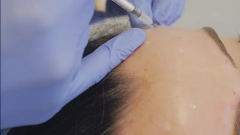 Botox Injection On The Forehead Stock Footage 130951020
