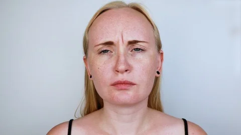 Botox injection in the forehead, remove the vertical wrinkle. Young woman on rec Stock Footage 112888030