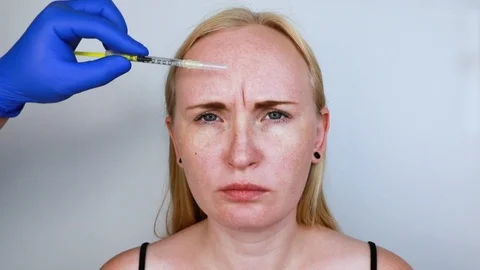 Botox injection in the forehead, remove the vertical wrinkle. Young woman on rec Stock Footage 112888113