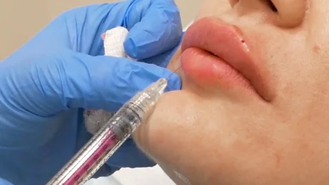 Botox injections for lip augmentation 스톡 동영상 69768548