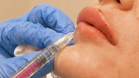 Botox injections in lips Stock Footage 69769376