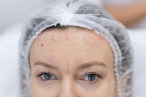 Botulinum Therapy Procedure Focused on Forehead Area, Showcasing Patient Stock Photos
