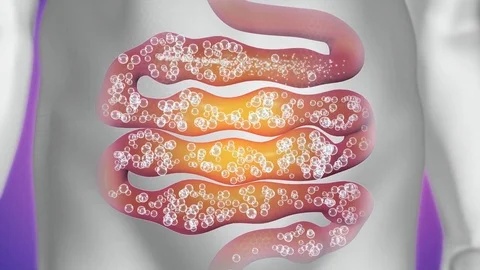 Bowel Flatulence treatment. Stock Footage 80631279